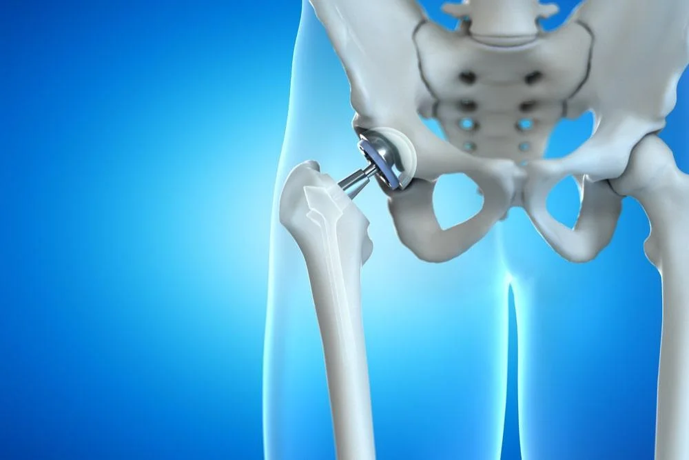 Robotic Hip Replacement