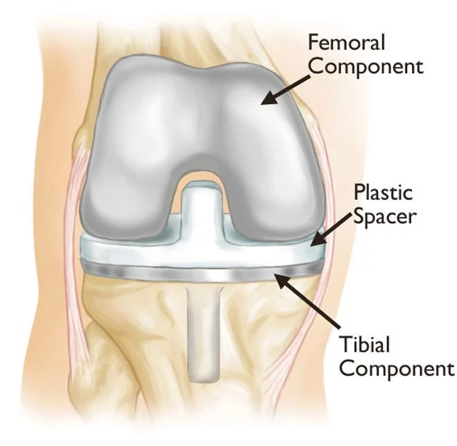 Primary Knee Replacement