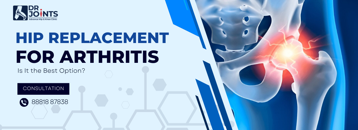 Hip Replacement for Arthritis Patients – Is It the Best Option